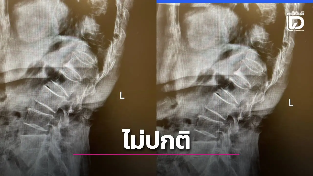 'ตัวเตี้ยลง-หลังค่อม' ไม่ใช่เรื่องปกติคนแก่! 'หมอเก่ง' เตือนภัยเงียบ 'กระดูกพรุน' ภัยร้ายที่มาแบบไม่เจ็บ