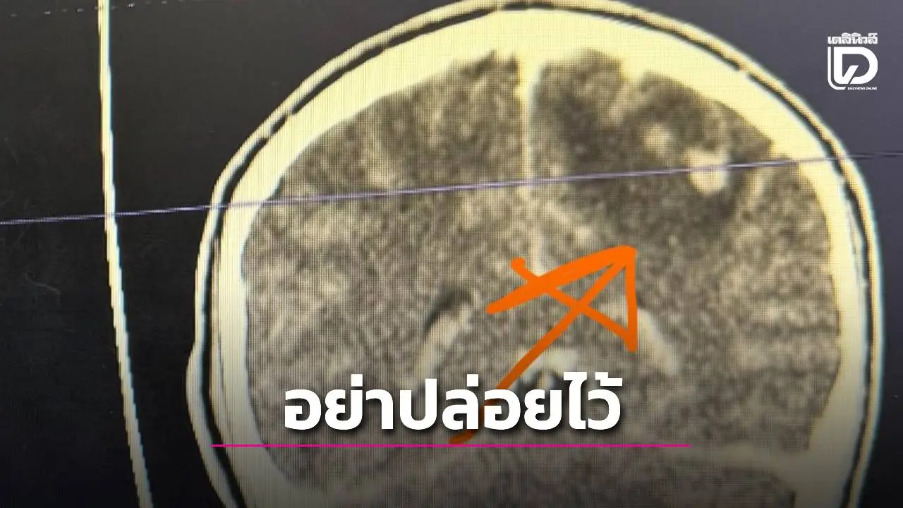 อุทาหรณ์หนุ่มวัย 19! 'ฟันผุ' อย่าปล่อยไว้ อันตรายถึงขั้น 'ฝีขึ้นสมอง' ทำชัก-สมองบวม