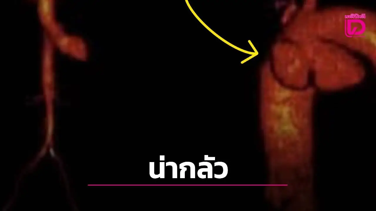 แค่ 'เสียงแหบ' แต่เกือบตาย! หมอผงะเจอ 'ซิฟิลิส' กัดกินเส้นเลือดหัวใจจนโป่งพอง-ซ้ำเติมเจอมะเร็งปอด!