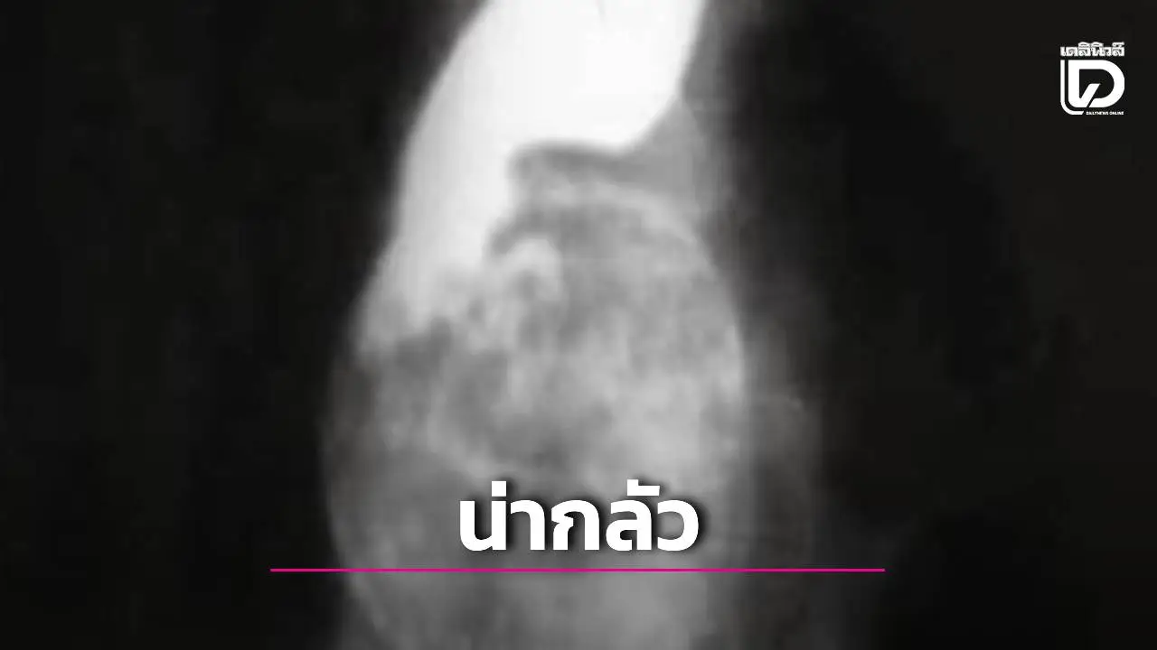 เตือนสายผักดิบ! พยาธิไส้เดือนบุกปอด-คาหลอดอาหาร อุทาหรณ์ล้างไม่สะอาด'
