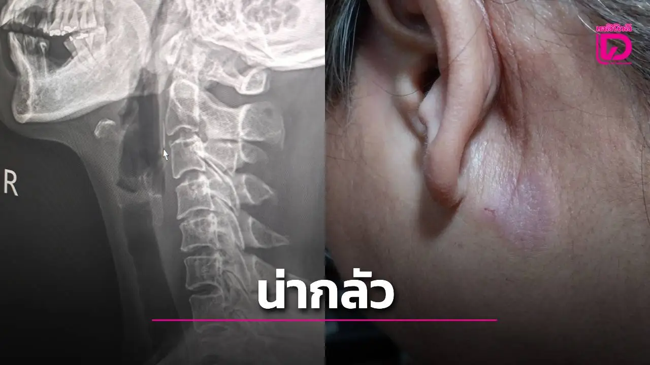 สยองข้ามคืน! ก้างปลาติดคอ 11 วัน ทิ่มทะลุผิวหนังออกมาหลังหู เจ้าตัวใจเด็ดดึงออกเลือดพุ่งกระฉูด