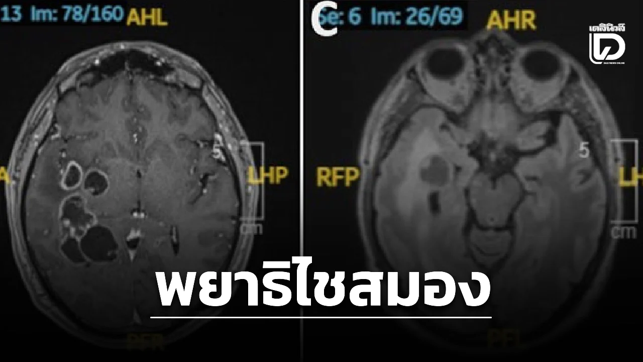 ขนลุก! หมอตรวจคนไข้ คาดเป็นมะเร็งสมอง แต่กลับพบตัวอ่อนพยาธิเต็มกะโหลก