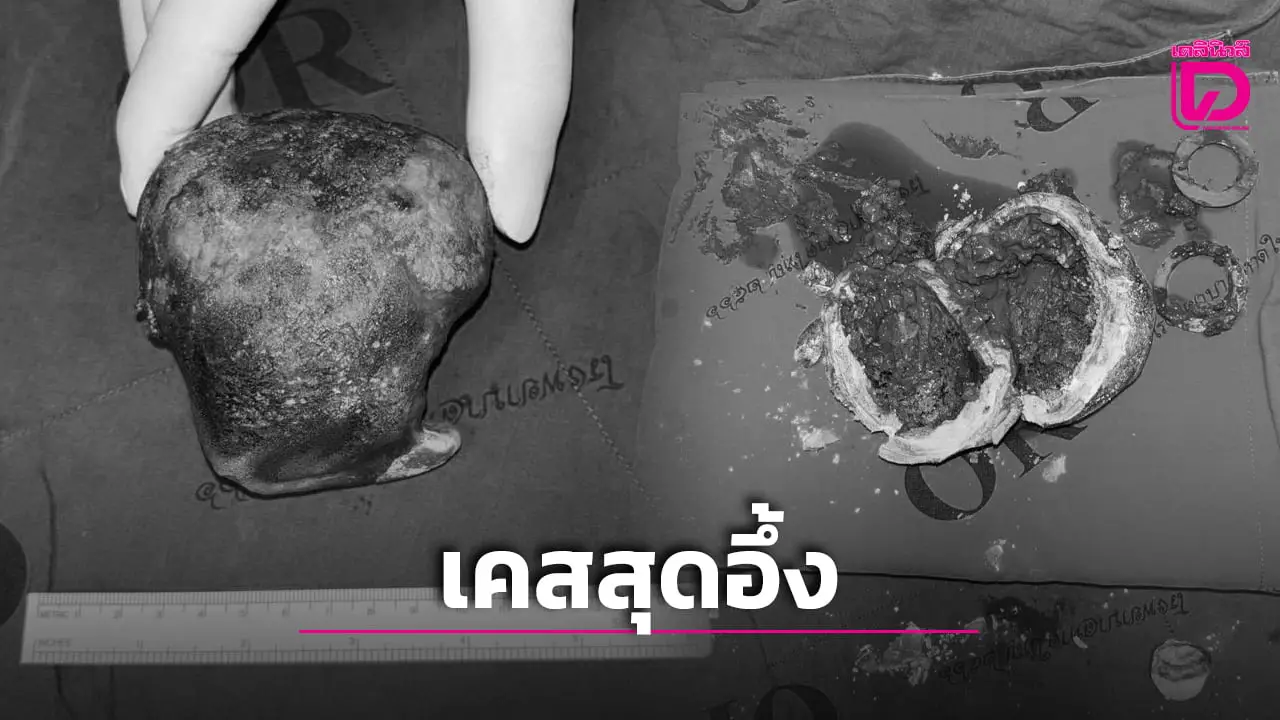 ใหญ่เท่ากำปั้น! ‘ทีมแพทย์ รพ.ศูนย์หาดใหญ่’ เปิดเคสสุดอึ้งสาวไทยเจอหินทั้งก้อนในท้อง!