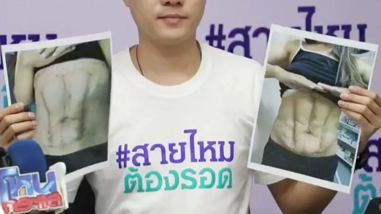 อวสานฝันร่อง 11 สาวจ่ายเงินเฉียดแสนดูดไขมัน แต่ไม่เป็นดังใจ ไม่กล้าโชว์ตลอดชีวิต